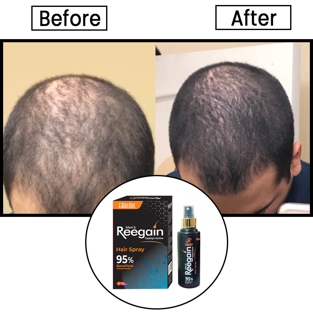Hair fall Treatment